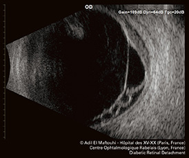 Echo2