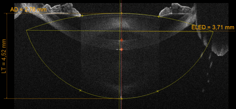 Biometria do cristalino com medida do ELED no MS-39 CSO