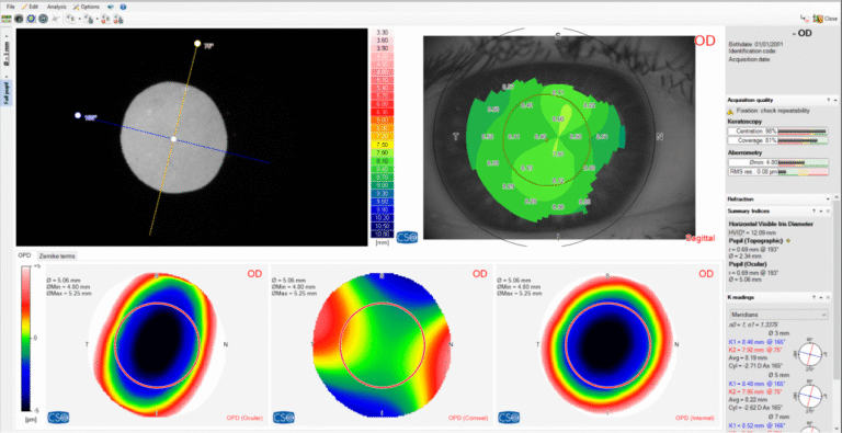 Mapas de aberrometria OPD ocular, corneal e interna no OSIRIS-T CSO